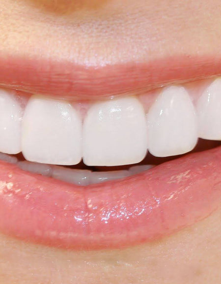 Perfect Smile press on  true smile clip on teeth imako cosmetic teeth veneers teeth clip in zefte  faux fix top front  press on  insta smile - ehabal