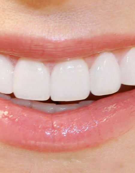 Zefte-cheap Instant Smile Teeth veneer over the counter - Ezaky