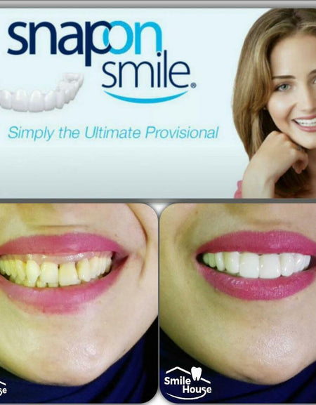 Best Snap On Smile Teeth Veneer top & Bottom. - ZefTe