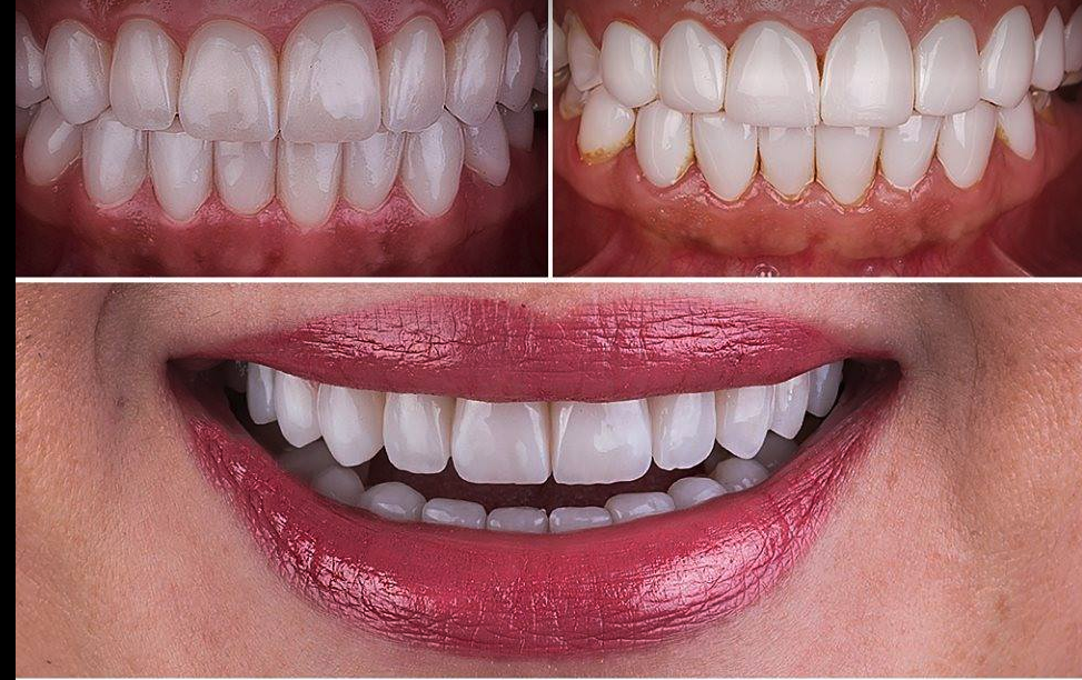 Zefte Snap On Veneers Clip On Teeth Cover Women & Men New 2018 Design one size - ZefTe