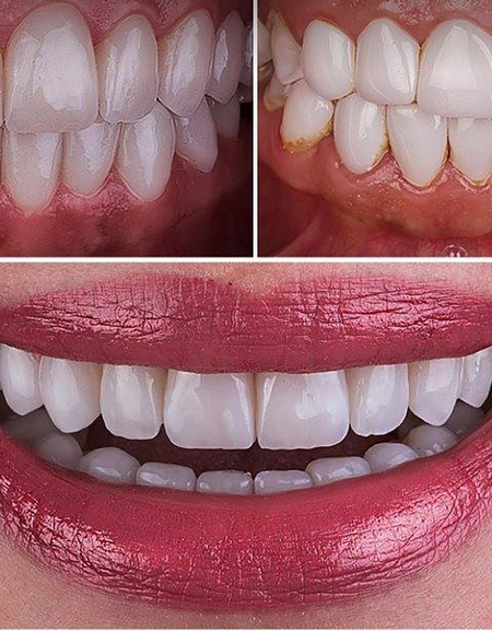 Zefte Snap On Veneers Clip On Teeth Cover Women & Men New 2018 Design one size - ZefTe