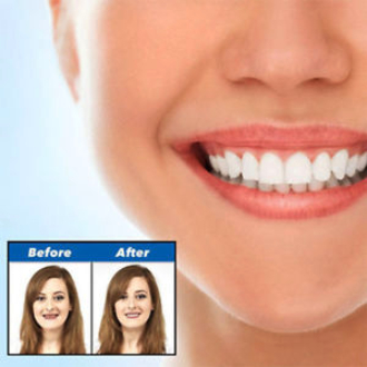 The Original Snap On Smile Amazing Perfect & Confident Smile Clip On  Veneers. - ZefTe