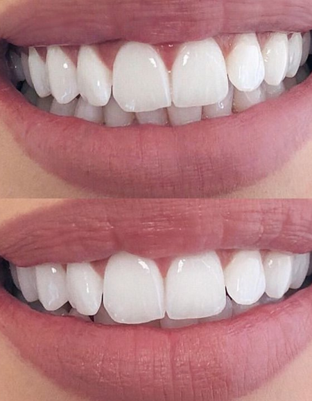 Snap On Smile Veneers Top & Bottom