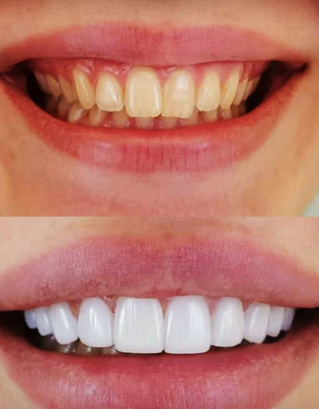Best  Amazing Perfect & Confident Smile Clip Veneers.